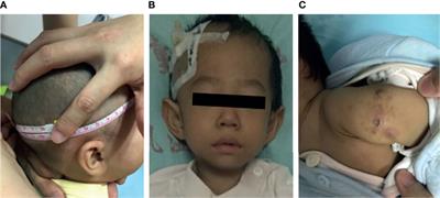 Characterization of a Cohort of Patients With LIG4 Deficiency Reveals the Founder Effect of p.R278L, Unique to the Chinese Population